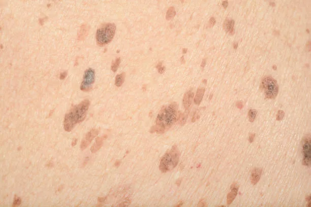 Hyperpigmentatie Melasma</p>
<p>Wat is pigment?<br />
onder invloed van zonlicht of hormonen worden pigmentcellen aangezet om een kleurstof te maken. Dit pigment wordt vervolgens via uitlopers van pigmentcellen overgebracht naar de omringende huidcellen.</p>
<p>Wat is de oorzaak van hyperpigmentatie?<br />
hyperpigmentatie is een toename van pigment in de huid. Dit pigment (kleur) neemt toe doordat het aantal van pigmentcellen toeneemt of doordat de pigmentaanmaak toeneemt terwijl de aantal aan pigmentcellen gelijk blijft.</p>
<p>Hyperpigmentatie Melasma</p>
<p>