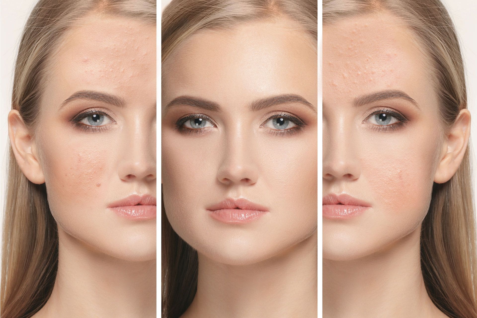 acne behandeling amsterdam