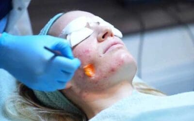 Acne behandeling