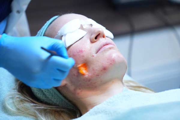 Acne behandeling amsterdam Acne behandeling amsterdam