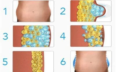 Cryolipolysis