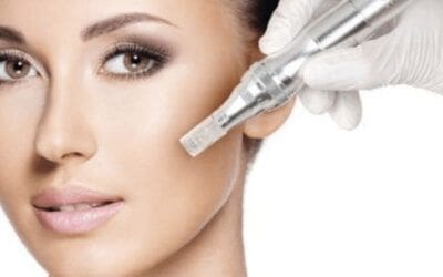 Microneedling