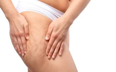 Cellulitis