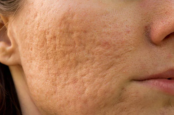 Acne littekens
