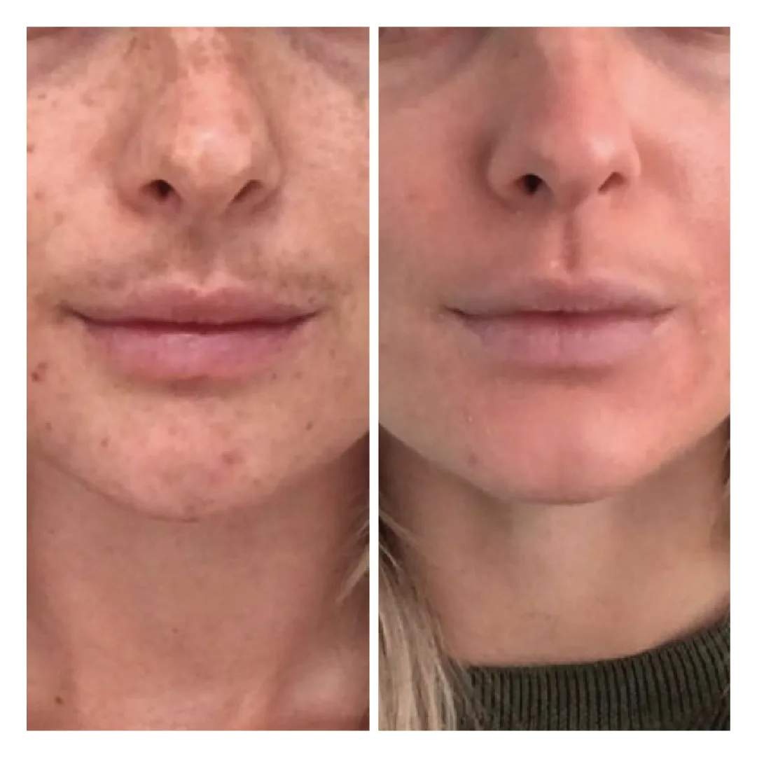 Fillers amsterdam fillers behandeling
