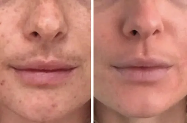 mesoestetic cosmelan dermalan