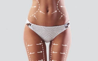 5-D HIFU Body treatment