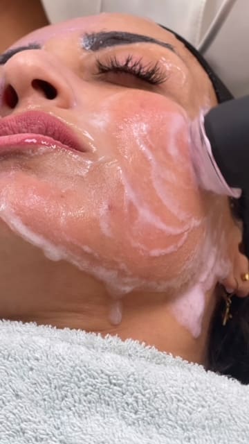 Microdermabrasion amsterdam