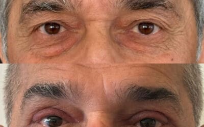 Ooglidcorrectie (Blepharoplastie)